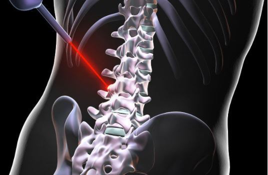 Laser Spine